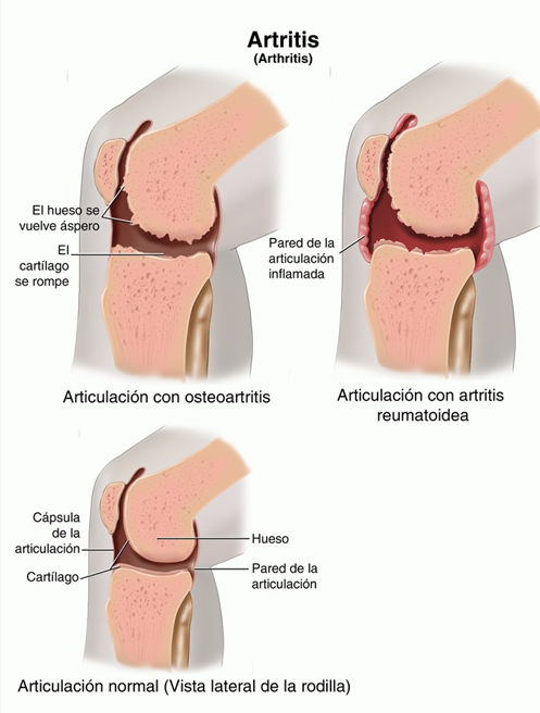 Artritis